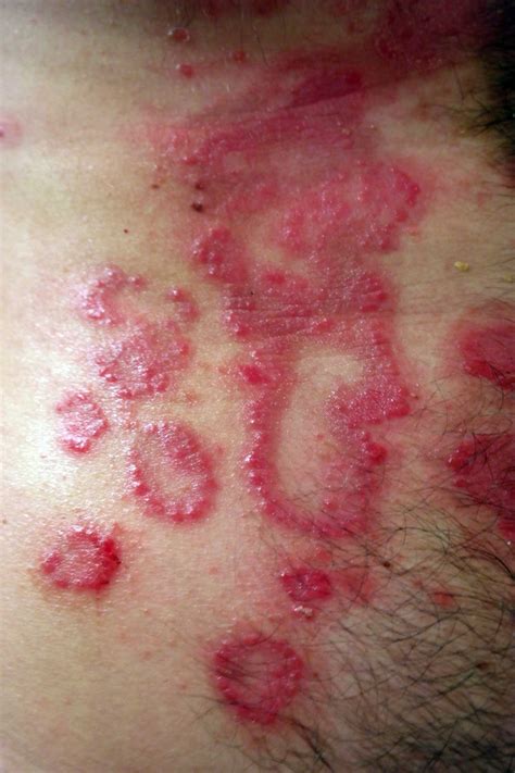 Psoriasis What is it? – Pictures, Causes, Symptoms, Treatment - I Need ...