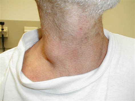 What Do Swollen Glands In The Neck Look Like - Infoupdate.org