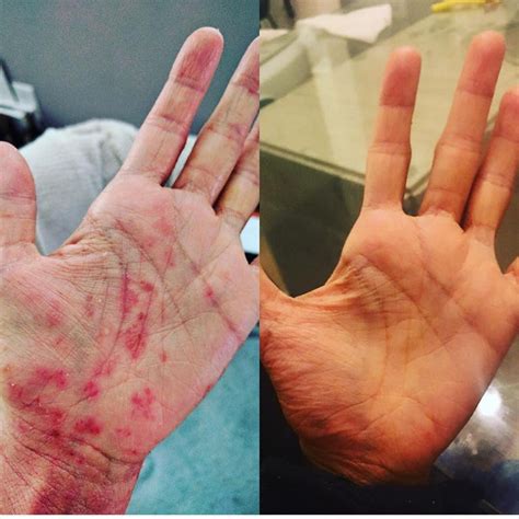 exercise  eczema   helps  tips    safely