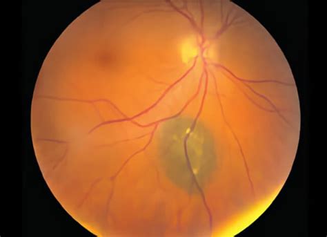 Choroidal Nevus Treatment | Retinal Consultants Medical Group