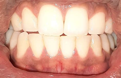 Gums hurt. Dentist says teeth are clean already. : r/Teethcare