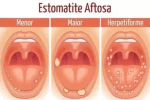 O Que É Estomatite Infantil - Estomatite no bebê: o que é, sintomas e tratamento (4 видео) | Med