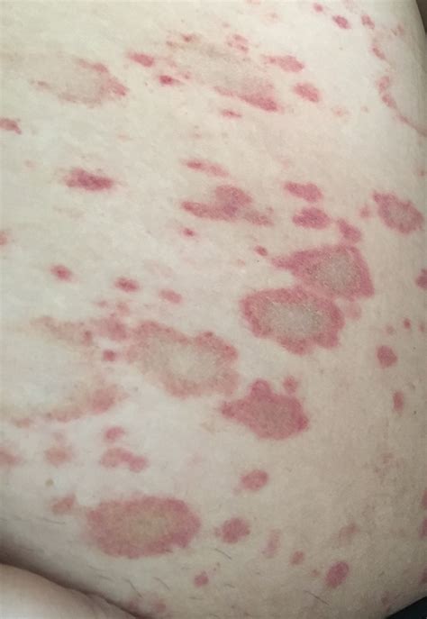 Ringworm Rash Image Pictures Photos - vrogue.co