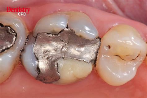 dentistry cpd saving  broken  molar