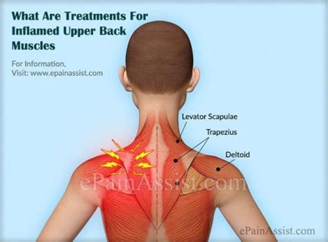 Back Pain Muscle Spasm Treatment