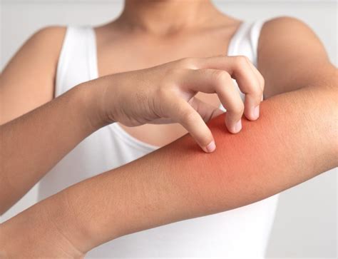 Urticaria: A Common Skin Condition Resulting In Itchy Hives - Allergy ...