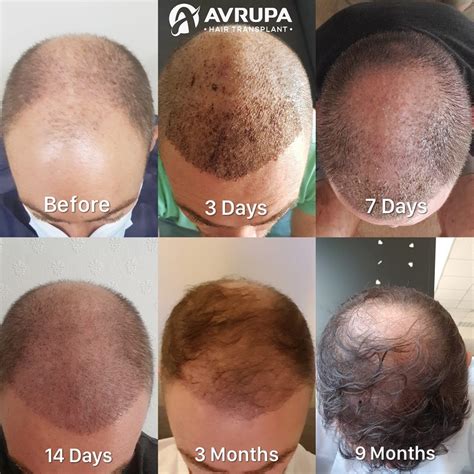 Hair Transplant Recovery Time: Expectations, Timeline & Precautions