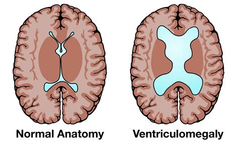 enlarged ventricles brain mri asymmetry   lateral ventricles