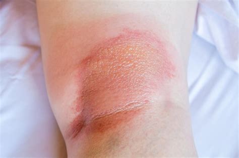Alergia Atras Do Joelho - Amostra de dermatite atópica eczema dermatite abaixo do joelho de perto ...
