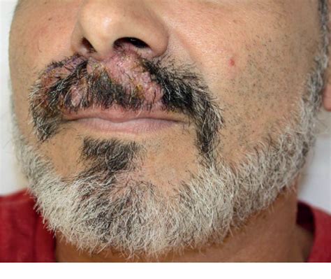 [PDF] An Unexpected Dermatophyte? Two Remarkable Cases of Tinea Barbae ...