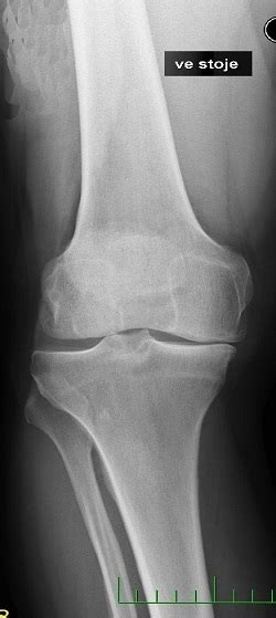 Artróza | Sport Medica