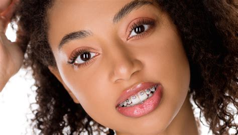 how long do you have to wear braces