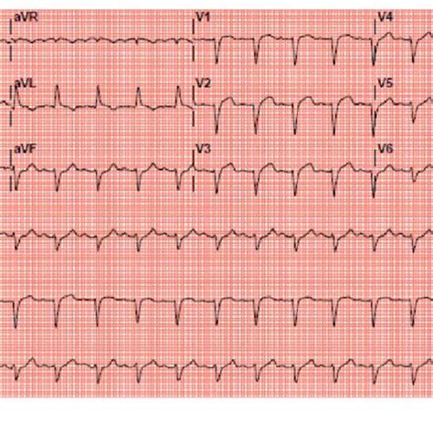 ECG showing sinus rhythm with left bundle branch block. | Download ...