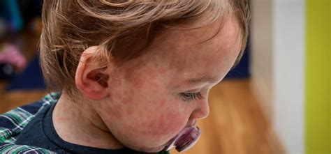 dosis  manfaat vitamin   infeksi campak  anak blog rey