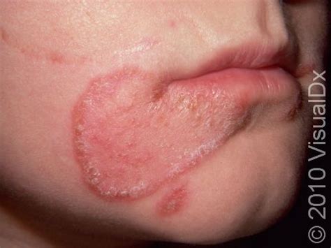 Ringworm Rash On Lips - Infoupdate.org