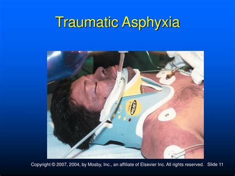 PPT - Chest and Abdominal Trauma PowerPoint Presentation, free download