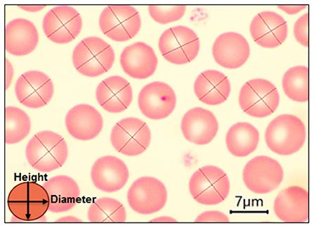 Erythrocytes Rbc Morphology Blood Smear Information | Mount Sinai