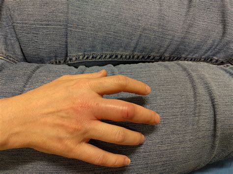 Flexor tenosynovitis – a name only a hand surgeon could love ...