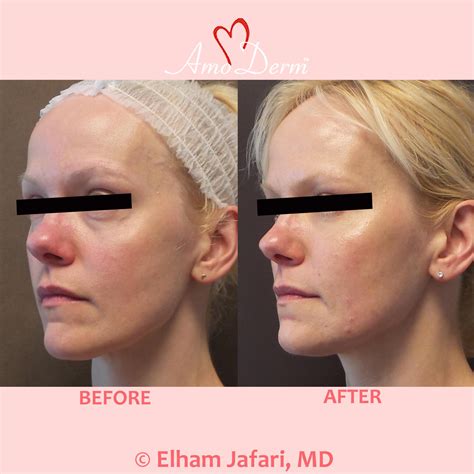 dark circles and bags under eyes 2