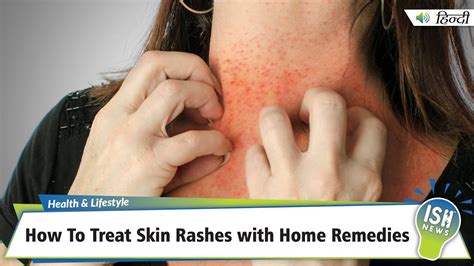 How To Treat Skin Rashes with Home Remedies | ISH News - YouTube