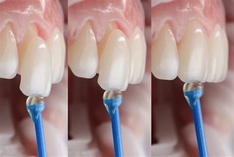 ¿Qué son las carillas dentales y cuándo hay que usarlas? - Gaceta Dental
