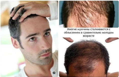 Как вернуть волосы на голове у мужчин: практические советы