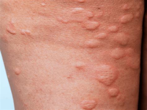 hives stratum dermatology clinics