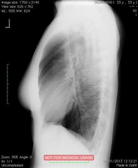 TB chronicles – Chest X-Ray, 2 Views – karenmagid