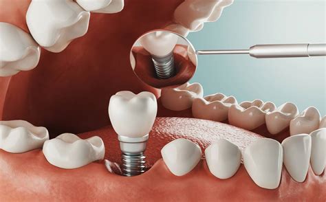 types  dental implants endosteal mini zygomatic