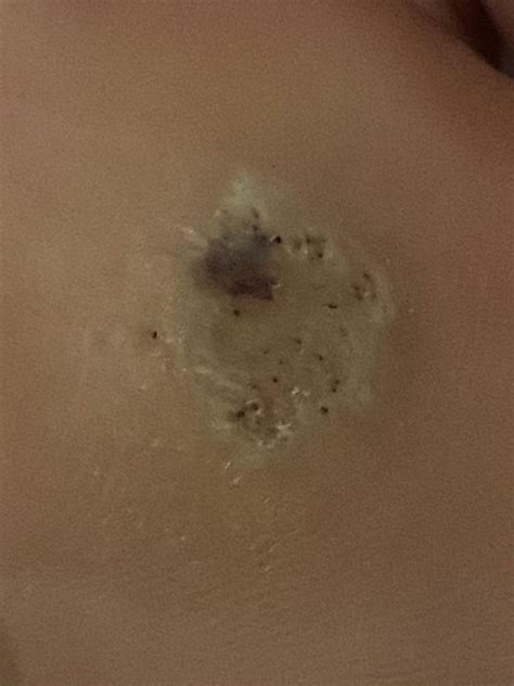 Help is my wart gone? I cut it off after using lots of treatments of