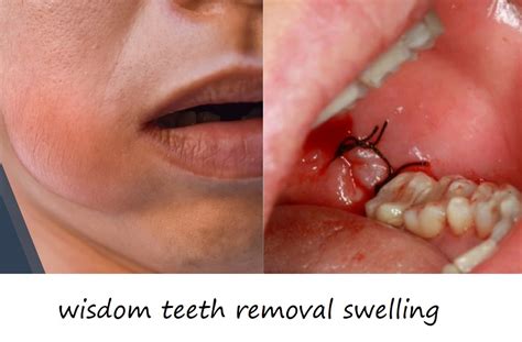 how to get swelling down after wisdom teeth removal