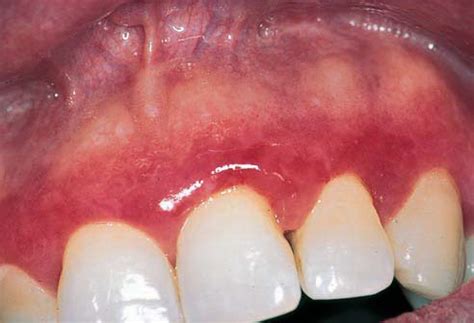 Red Lesions of the Oral Mucosa-Differential Diagnosis, Clinical ...