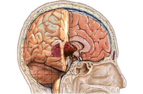 grade  tumour anaplastic astrocytoma