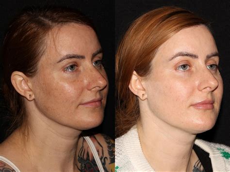 BBL™ PhotoFacial Before and After Pictures Case 6 | Chico, Yuba City ...