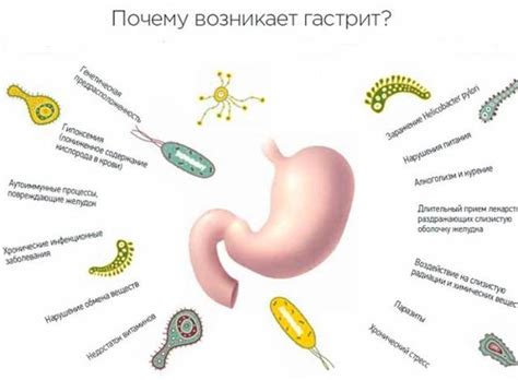 Причины гастрита желудка хронического и острого основные