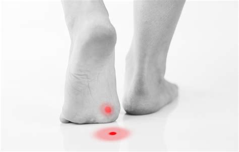 Verrucas - What are the causes? - Finchley Footcare