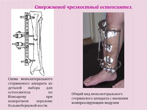 Основные принципы лечения переломов - online presentation