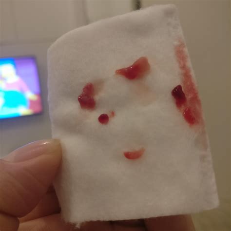 After a year, I was finally able to empty the ingrown cyst thing on my