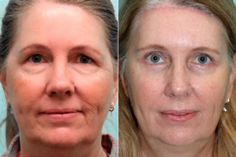undetectable beauty trend subtle facial surgery