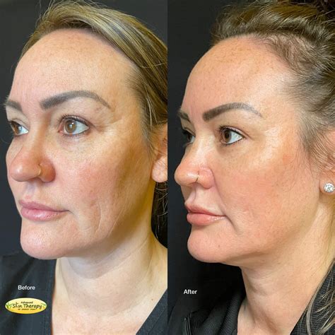 Arlington Botox Treatment Cost, Before & After Photos