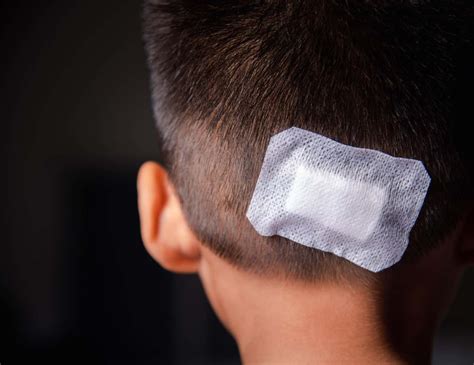 Galo Na Cabeça Termo Tecnico - Hematoma Subgaleal - O Popular "Galo" Na Cabeça - Aprenda Mais - Blog ...