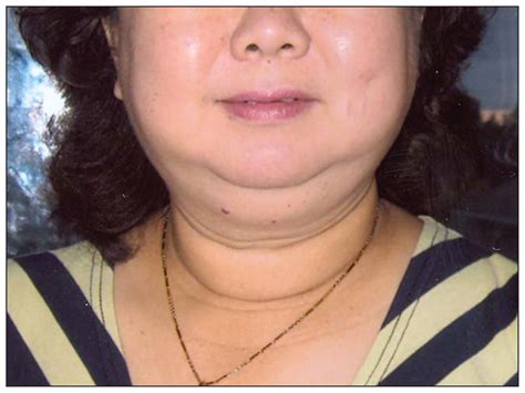 penyakit cushing syndrome  penyebabnya kondisi umum