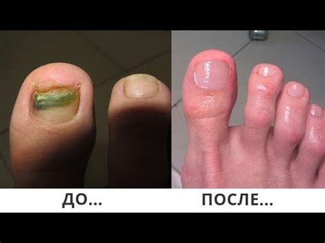 Копеечное ЧУДО-СРЕДСТВО от грибка ног - YouTube