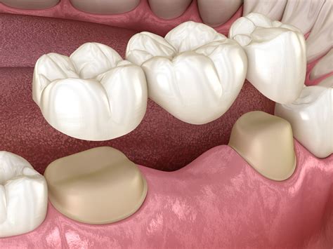 Dental Bridges - Batesville, MS - Batesville Dentistry