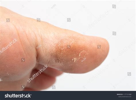 353 Callus On Big Toe Royalty-Free Photos and Stock Images | Shutterstock