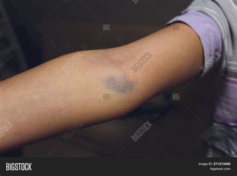 Bruises Blood Image & Photo (Free Trial) | Bigstock