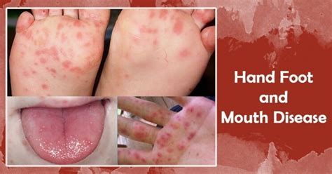 Hand, Foot, And Mouth Disease: Symptoms And Treatment | atelier-yuwa ...