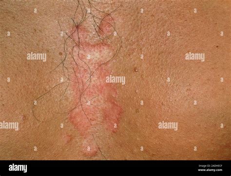 seborrhoeic dermatitis close    rash  seborrhoeic dermatitis