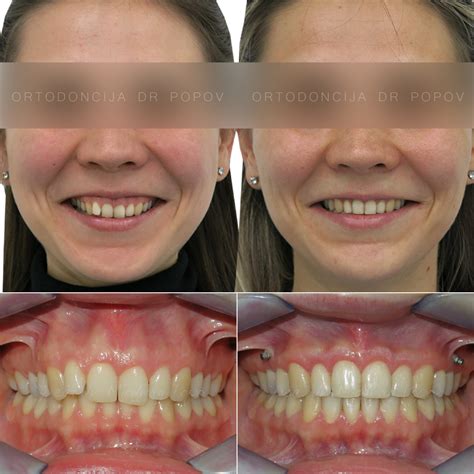 Gummy smile – Ortodoncija DR Popov