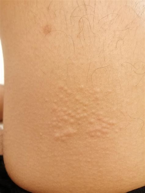 Just noticed this rash on mi leg, really itchy as of now. Any idea what